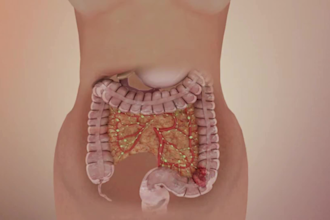 do 3d surgical animation 3d cancer surgery animation medical animation
