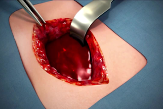 medical 3d animated video production, medical explainer video, real 3d animation