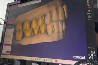 design your case in exocad