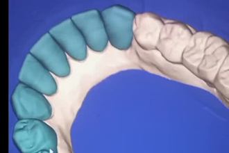 design professional dental restorations using exocad cad cam