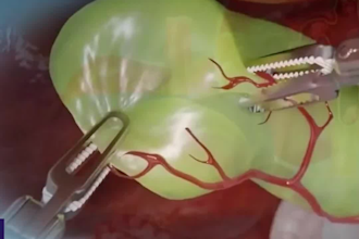 3d product ads, industrial animation, cad video modelling, cgi medical solidwork