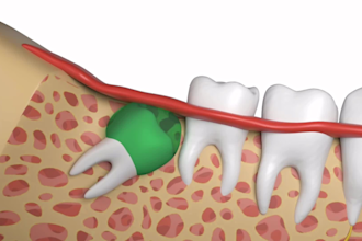 do 3d medical animation, surgery animation, 3d medical device, medical explainer