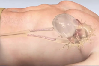 do 3d medical animation, 3d medical device, surgery animation, surgery modelling