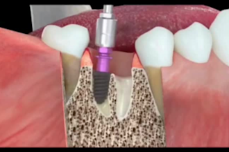 create 3d dental animation 3d medical model 3d medical animation 3d dental video