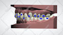 plan your clear aligner orthodontic case