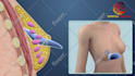 do 3d medical product and device animation
