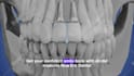 do 3d dental implant animation 3d abutmen crown explainer and surgery procedure