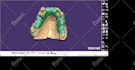 design crowns bridges using exocad