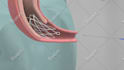 do 3d medical animation for a product or procedure