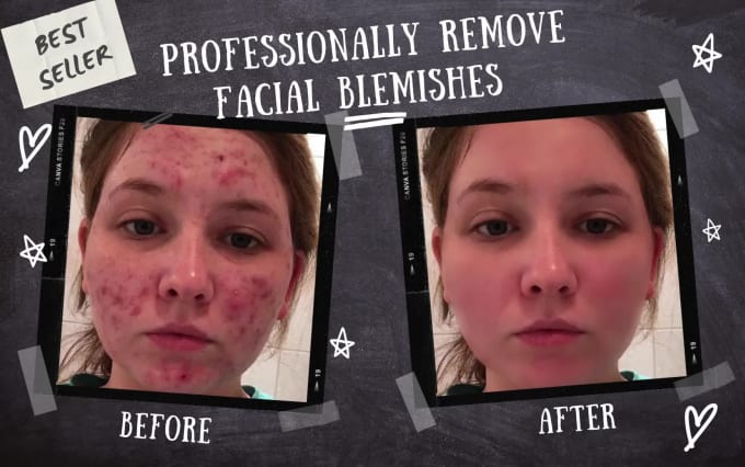 retouch your image remove pimples wrinkles acne and blemishes using photoshop