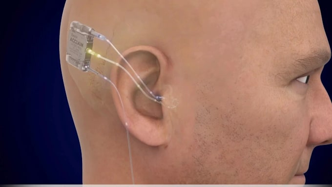 create 3d medical animation medical explainer ear surgical procedure animation