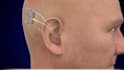 create 3d medical animation medical explainer ear surgical procedure animation