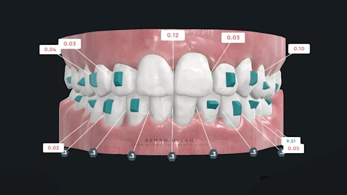 clear aligner treatment planning and orthodontic setup