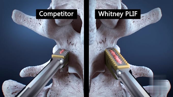 3d medical animation for orthopedic procedures surgical education ...