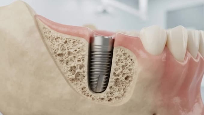 create 3d dental implant animation and medical explainer video