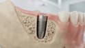 create 3d dental implant animation and medical explainer video
