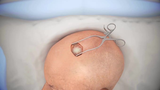 create realistic 3d medical animations 3d neurosurgery brain anatomy animation
