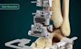 create 3d orthopedic implant medical device animation