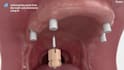 do 3d medical explainer 3d dental implant animation 3d dental surgical procedure