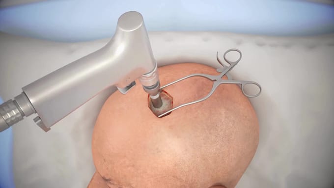 create realistic 3d medical animations 3d neurosurgery brain anatomy animation