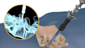 create3d medical device animation spine surgery orthopedic implant visualization