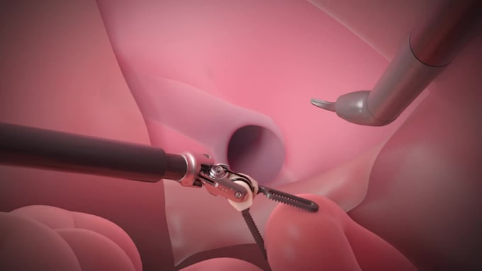 create realistic 3d surgical procedure animation surgical animation video