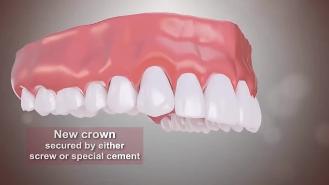 create well explanatory and realistic 3d medical animation video, dental video