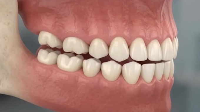 create realistic 3d dental implant animation, medical explainer video