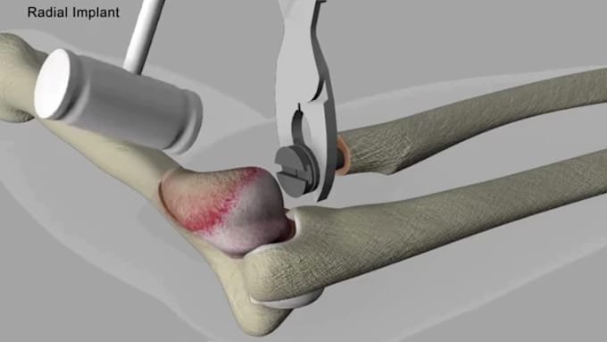 Create 3d medical surgery animation, medical device, skeletal ...