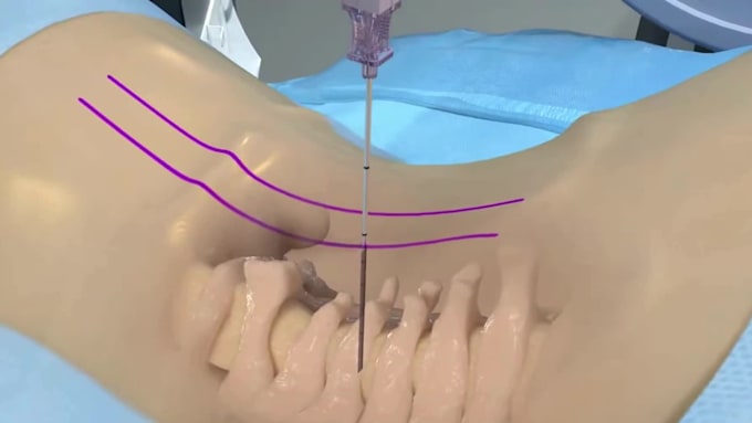 create 3d medical animation surgical animation surgical procedure video
