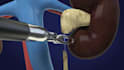 create 3d medical animation surgical procedure urology surgery video