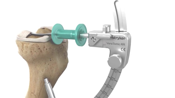 create 3d surgical procedure, medical device and anatomy visualization video
