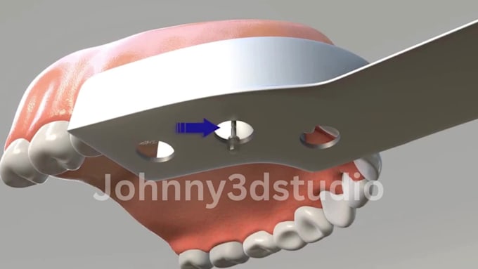 create 3d medical animation, dental implant and teeth surgery animation