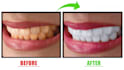 fix, whiten, and perfect your teeth smile in photoshop