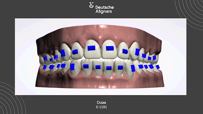 do aligners treatment planning using 3shape orthosystem
