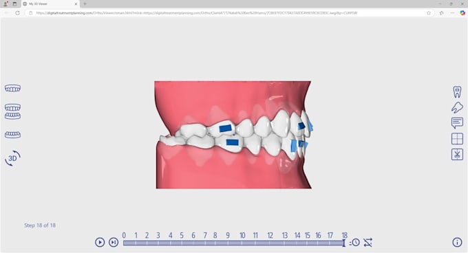 do dental clear aligners treatment planning,setup design on onyxceph software