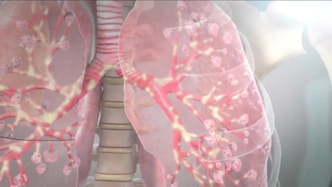 Procedure Failure Animation Medical explainer video 3d medical illustration surgical procedure ...