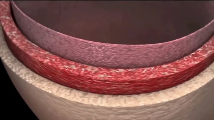 Procedure Failure Animation Animation médicale 3d, animation chirurgicale, procédure chirurgicale ...