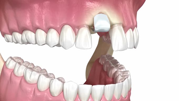 Do super quality 3d medical animation video, 3d dental implant with hd ...