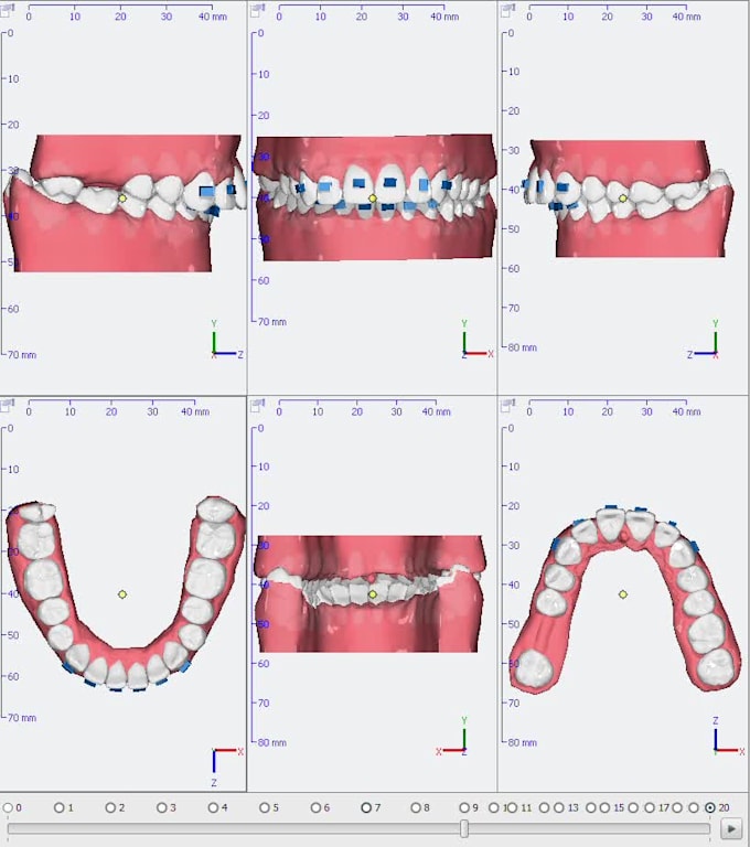 Be your virtual orthodontist, aligner treatment planner by Mfaisalafzal ...