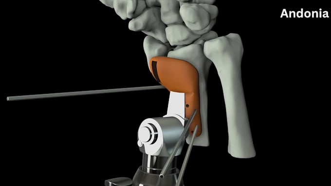 do 3d medical animation, 3d surgical animation, 3d radius implantation animation