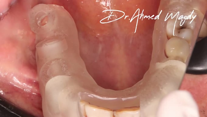 do implant planning, surgical guides, and stackable guides