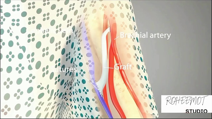 Procedure Failure Animation Create 3d medical animation, medical illustration, surgical procedure ...