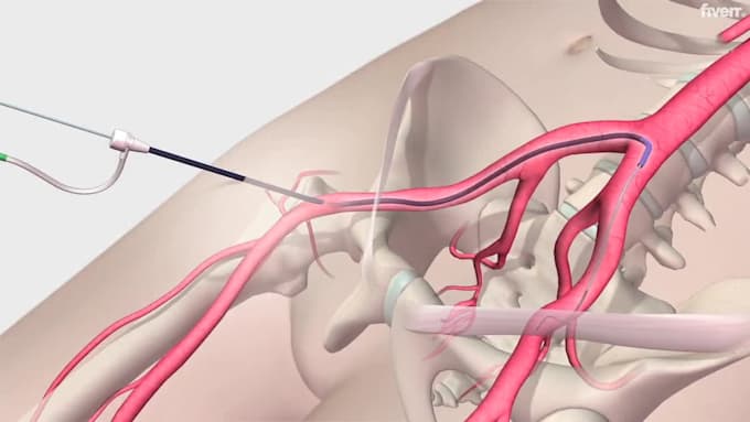 create 3d medical animation, medical video, surgery