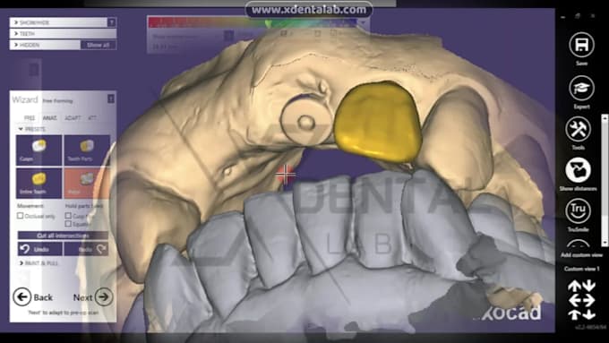 design crowns and bridges in exocad