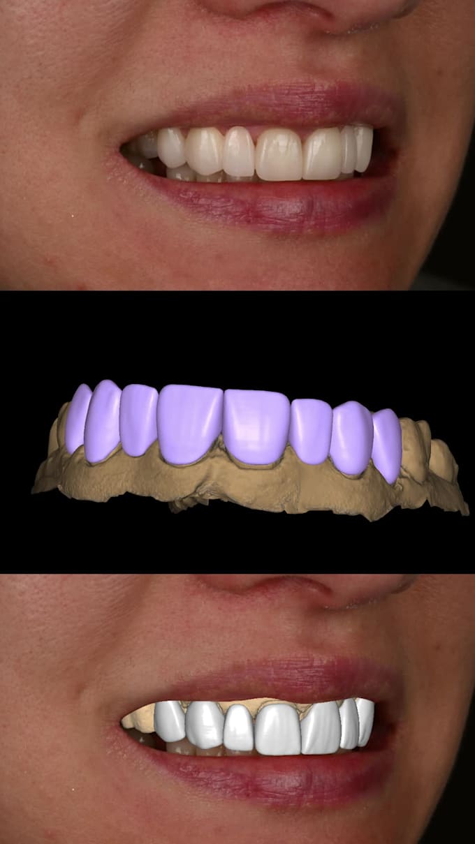 do digital wax up dsd using exocad