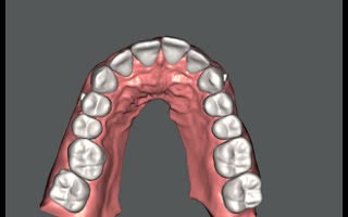 plan your clear dental aligners treatment