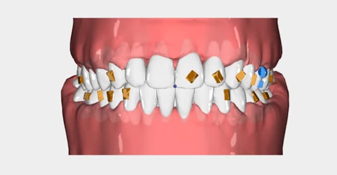 design clear aligner treatment plans