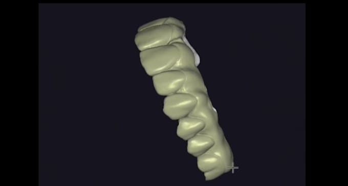 design dental cad crowns, bridges and implants using exocad