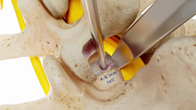 create 3d spinal implant animation orthopaedic medical visualization